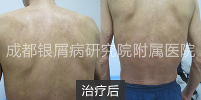 治疗后.jpg