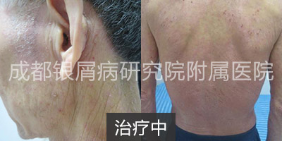 治疗中.jpg