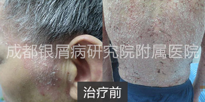 治疗前.jpg