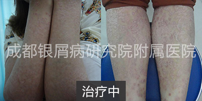 治疗中.jpg
