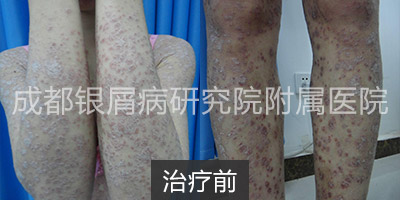 治疗前.jpg