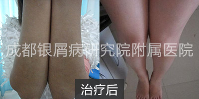 治疗后.jpg