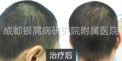 治疗后.jpg