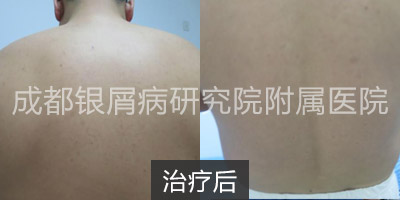 治疗后.jpg
