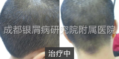 治疗中.jpg