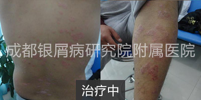 治疗中.jpg