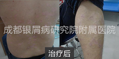 治疗后.jpg