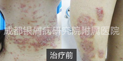 治疗前.jpg