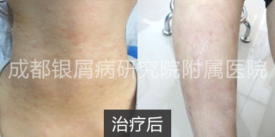 治疗后.jpg