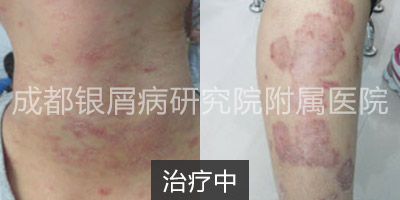 治疗中.jpg