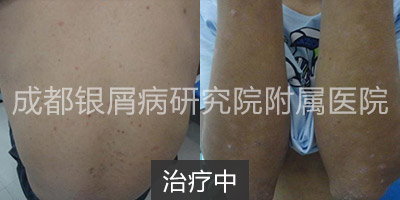 治疗中.jpg