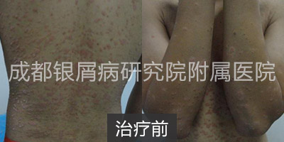 治疗前.jpg