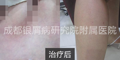 治疗后.jpg