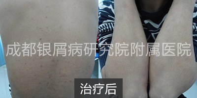 治疗后.jpg