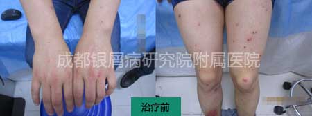 治疗前.jpg