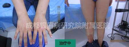 治疗中.jpg
