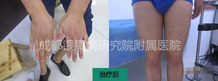 治疗后.jpg