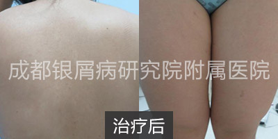 治疗后.jpg