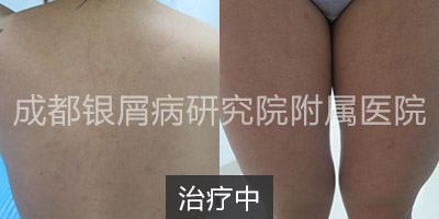治疗中.jpg