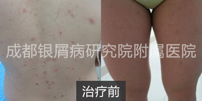 治疗前.jpg