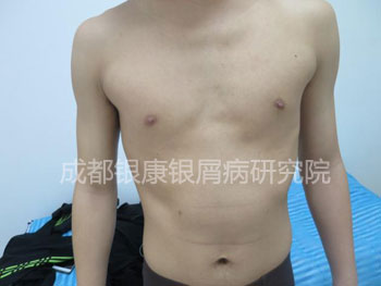 治疗后.jpg