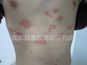 治疗前.jpg
