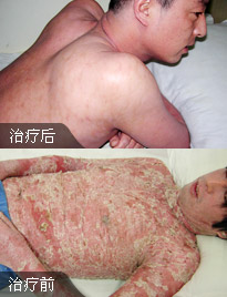 男性银屑病.jpg